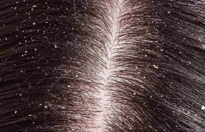 dandruff